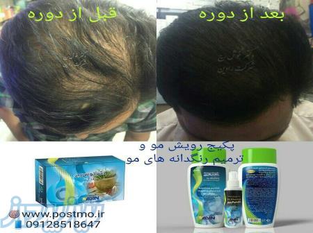 رویش مجدد موی سر 