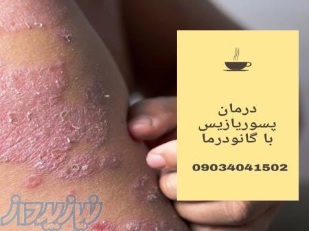 بهبود و درمان بدون بازگشت بیماری صدف ( پسوریازیس) 