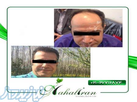 کاشت مو در نهال ایران 