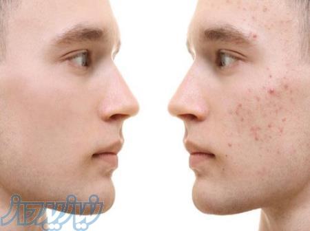 از بین بردن جای جوش و زحم های پوستی و لیفت صورت با کمپلکس لیزر co2 و rf کلینیک آریس جردن