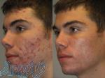 درمان جوش صورت توسط لیزر آلمانی کلینیک آریس جردن