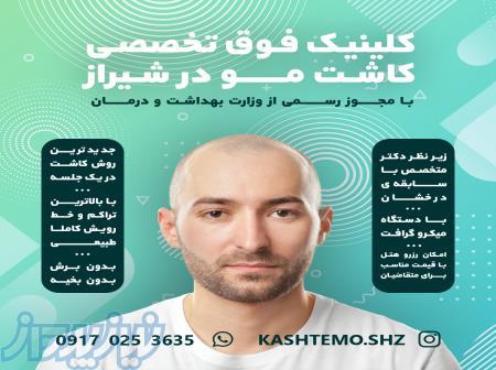 کاشت موی طبیعی در شیراز 