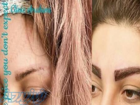 کاشت مو، ابرو، ریش 