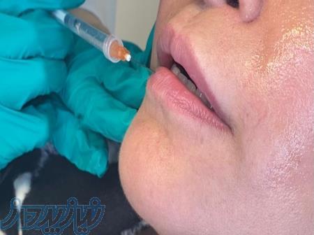 تزریق ژل ، بوتاکس ، فیلر 