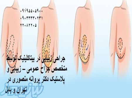 عمل زیبایی شکم، عمل زیبایی سینه و اندام