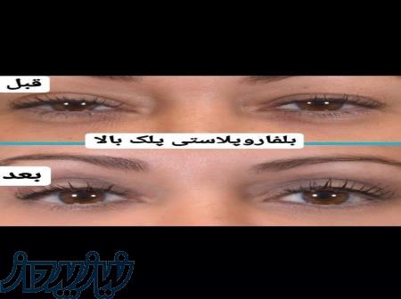تخفیف بهاره جراجی پلک بالا و پایین ( بلفاروپلاستی ) 