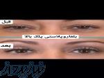 تخفیف بهاره جراجی پلک بالا و پایین ( بلفاروپلاستی ) 