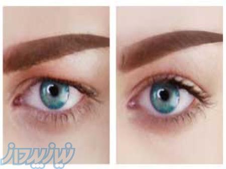 چشمانی زیبا و نافذ با رفع پف چشم 