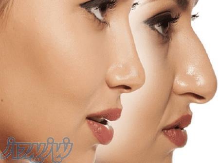 فرم دهی بینی بدون جراحی 