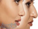 فرم دهی بینی بدون جراحی 