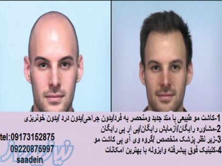 کاشت مو طبیعی با بهترین کیفیت و خدمات رایگان 