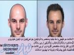 کاشت مو طبیعی با بهترین کیفیت و خدمات رایگان 