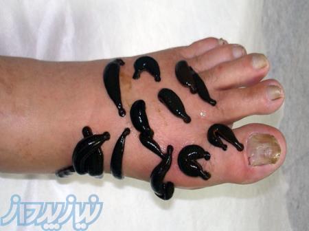 زالو درمانی در منزل ، قیمت زالو درمانی