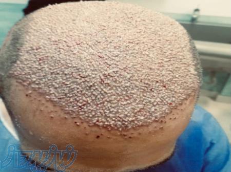 کاشت مو - ریش - ابرو 