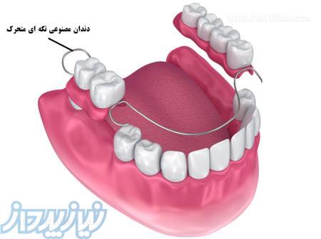 تعمیر دندان مصنوعي شکسته