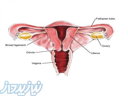 آندومتریوز 