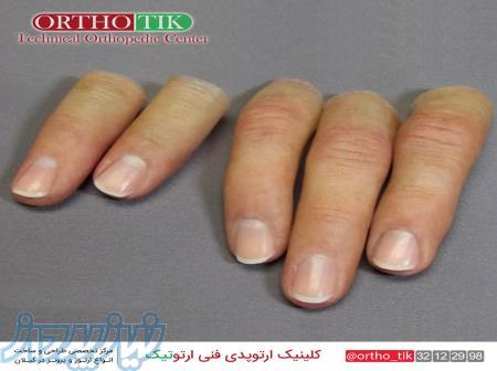 ساخت پروتز زیبایی اگشت 