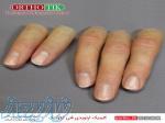 ساخت پروتز زیبایی اگشت 