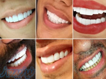 کامپوزیت دندان طرح لبخنددندانپزشکی دایموند 