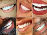 کامپوزیت دندان طرح لبخنددندانپزشکی دایموند 