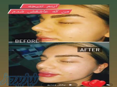 تزریق ژل و بوتاکس و انواع مزو 