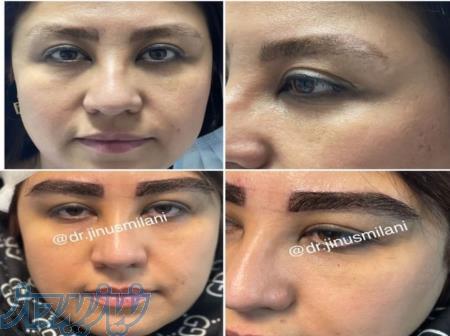 کاشت ابرو کاملا طبیعی و 100  تضمینی و پرتراکم 