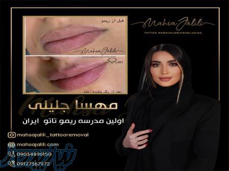 ریموو تاتو خط لب باجدیدترین تکنیک های پاک کردن تاتو 