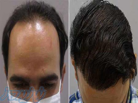 کاشت مو و ابرو 