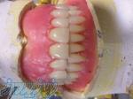 دندانسازی فوری 