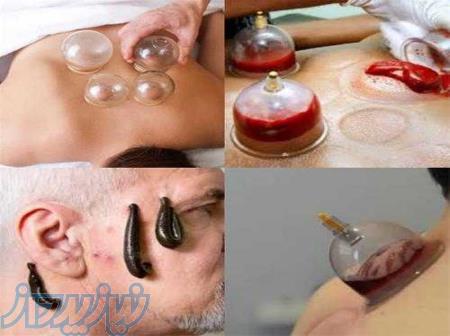 حجامت  به صور حرفه ای یاد بگیر 