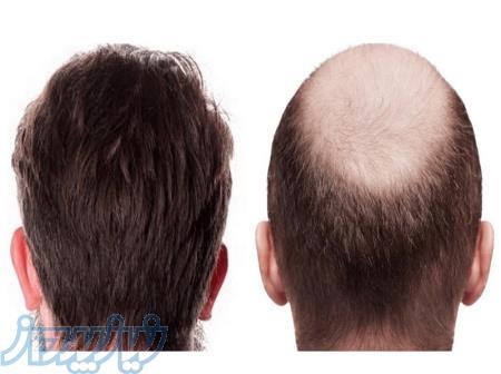 کاشت مو با تخفیف ویژه 