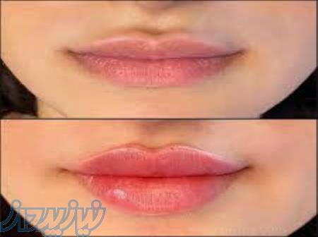 تزریق ژل لب در اصفهان 
