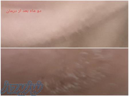 الکترولیز مو زائد سفید