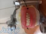 دندان مصنوعی طبیعی 
