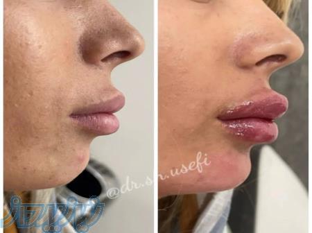 حراج بزرگ تابستانه تزریق ژل و بوتاکس 