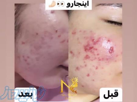 فیشال و پاکسازی تخصصی مزونیدلینگ لیزر 