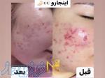 فیشال و پاکسازی تخصصی مزونیدلینگ لیزر 