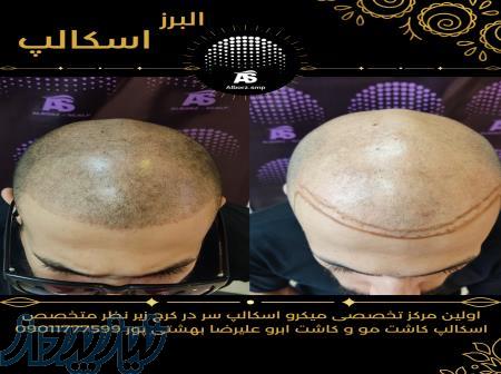 اسکالپ سر میکرو اسکالپ در کرج 