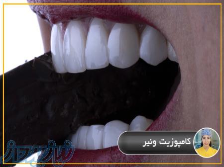 كامپوزيت ونير 