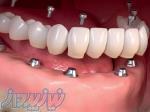 ایمپلنت دندان در کرج 