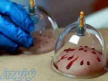 آموزش حجامت - زالو درمانی و بادکش 