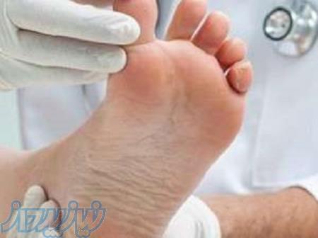 مرکز معتبر درمان پای دیابتی در آبیک 