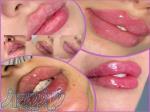 آموزش تزریق ژل و بوتاکس ، آموزش تزریق چربی و فیلر لب 