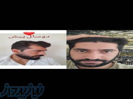 کاشت مو شیرازی در تهران 