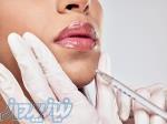 تزریق ژل لب طبیعی 