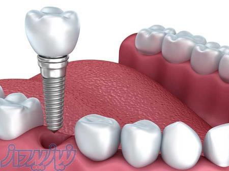 ایمپلنت ایرانی 