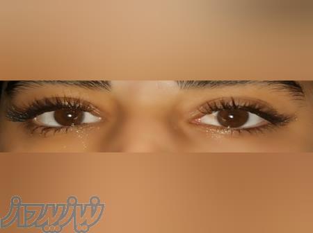 کاشت مژه هیدن (موقت) 