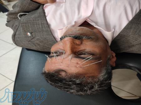 آموزش طب سوزنی 