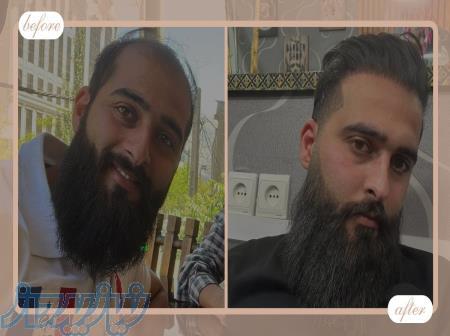 کاشت مو و ابرو با پرداخت 8 تومن و قسطی
