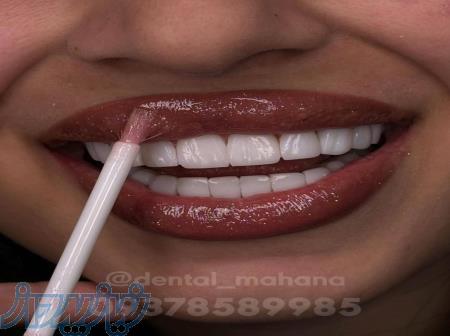 کامپوزیت دندان ایمپلنت لمینت عصب کشی کلینیک ماهانا 